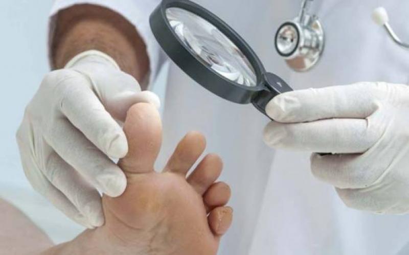 Как вылечить грибок ногтей на ногах: народные средства